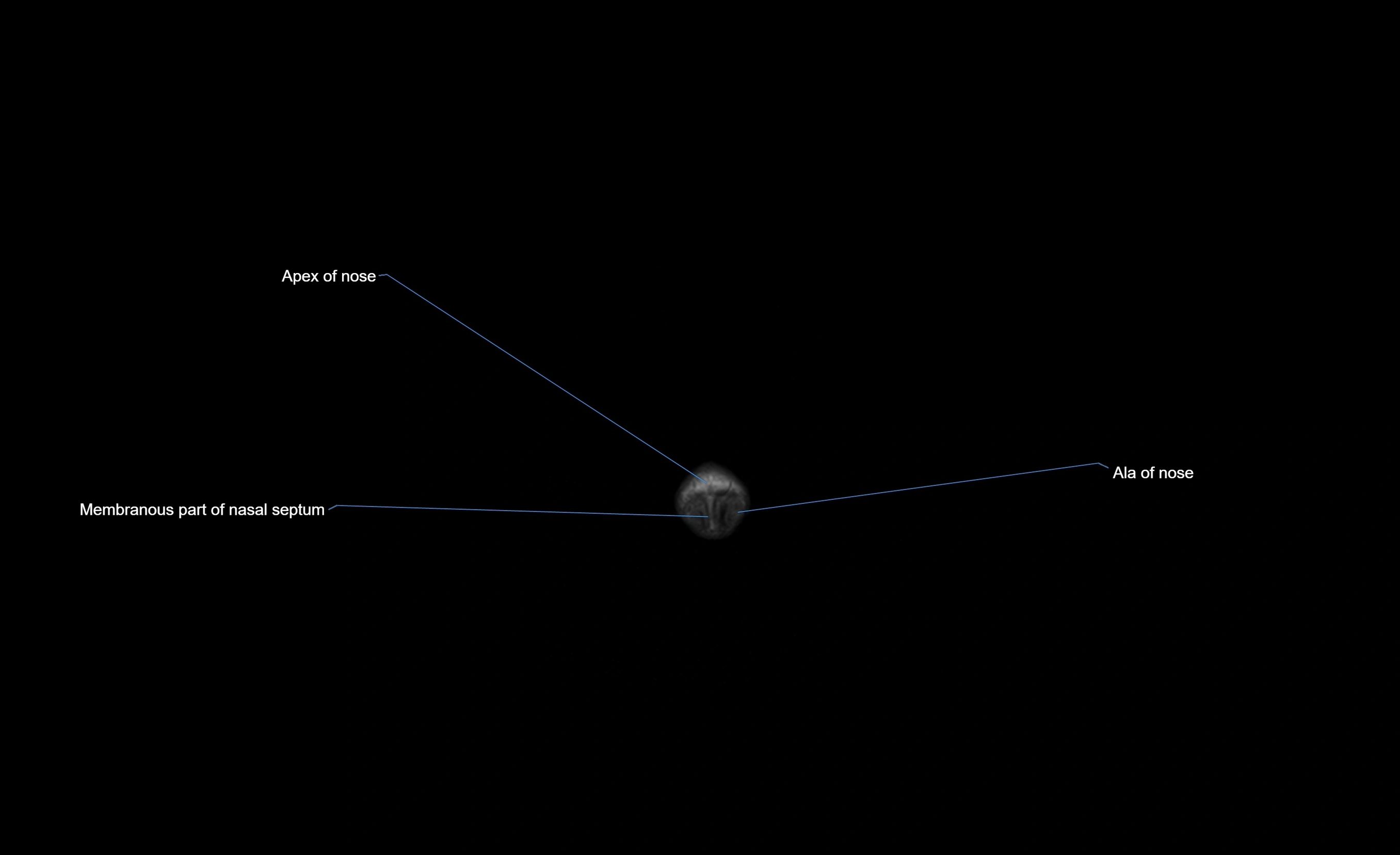 MRI face & paranasal sinuses(PNS) labelled  coronal  cross sectional anatomy 3T radiology  image-img-00001-00001.webp